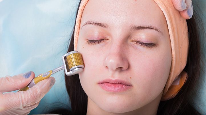 What Does Microneedling Do: Here Are The Answers